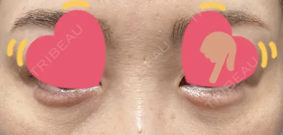 ヒアルロン酸注入（涙袋） PRO CLINIC プロクリニック 銀座院 AFTER メイン用