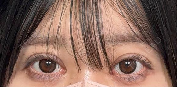 二重埋没 アリエル美容クリニック 郡山院 AFTER メイン用