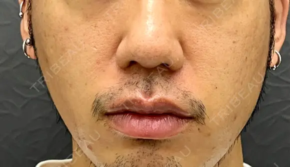 小鼻縮小（切開） 渋谷の森クリニック AFTER メイン用