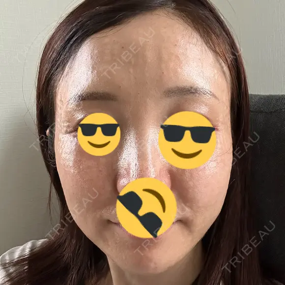 水光注射（ハリ・美肌） Chloe Cheongdam Clinic （クロエチョンダムクリニック） DAY 0 メイン用