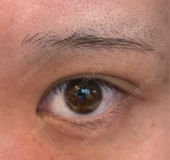 自然癒着法 / ヒアルロン酸注入（涙袋） CLINIC W DAY 7 メイン用