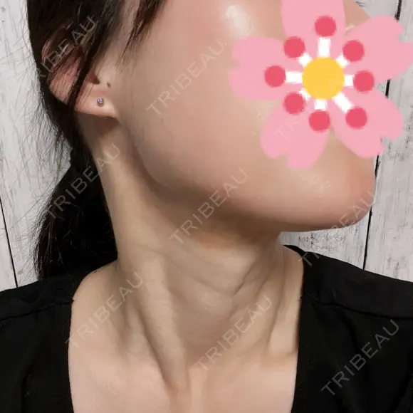 ルメッカ / インモード Moon Beauty Clinic DAY 3 メイン用