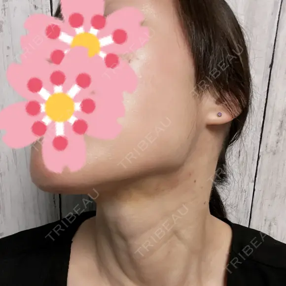 ルメッカ / インモード Moon Beauty Clinic DAY 3 メイン用