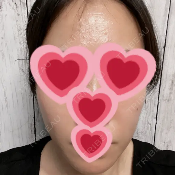 ルメッカ / インモード Moon Beauty Clinic DAY 3 メイン用