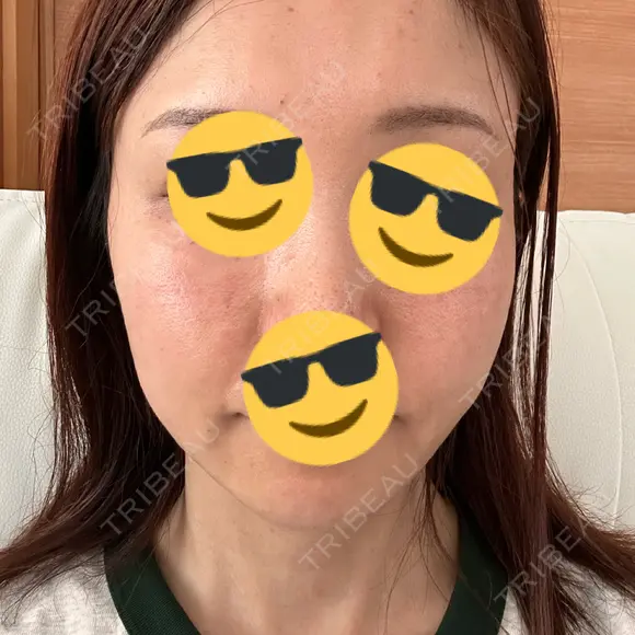 水光注射（ハリ・美肌） Chloe Cheongdam Clinic （クロエチョンダムクリニック） DAY 1 メイン用