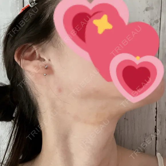 ルメッカ / インモード Moon Beauty Clinic DAY 4 メイン用