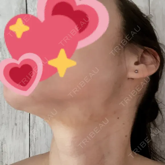 ルメッカ / インモード Moon Beauty Clinic DAY 4 メイン用