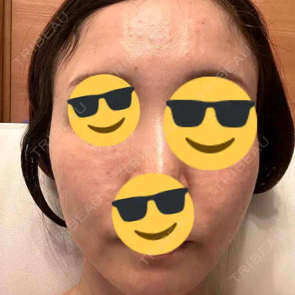 水光注射（ハリ・美肌） Chloe Cheongdam Clinic （クロエチョンダムクリニック） DAY 1 メイン用