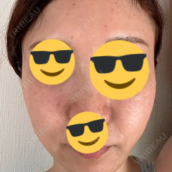 水光注射（ハリ・美肌） Chloe Cheongdam Clinic （クロエチョンダムクリニック） DAY 2 メイン用