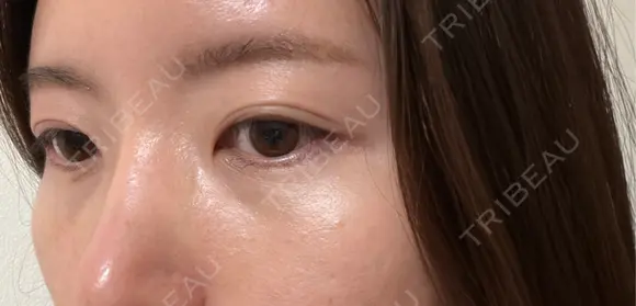 水光注射（ハリ・美肌） GLAMRULE CLINIC (グラムルール クリニック) 銀座院 AFTER メイン用