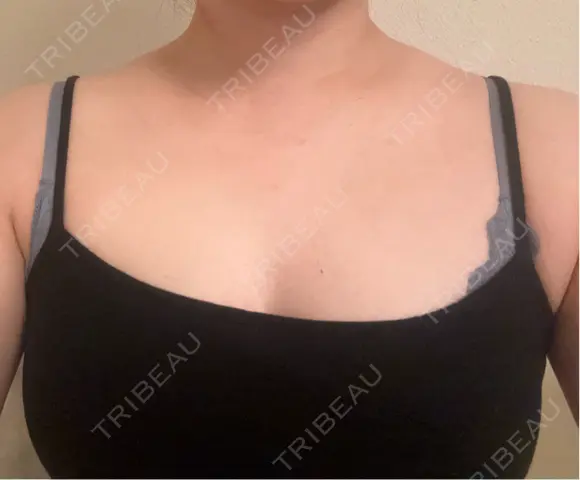 ボトックス（肩） APスキンクリニック銀座 DAY 7 メイン用