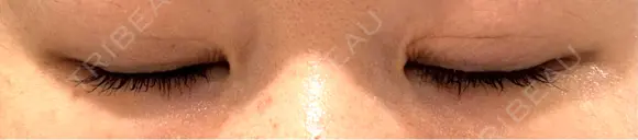 二重埋没 アリエル美容クリニック 大宮院 DAY 34 メイン用
