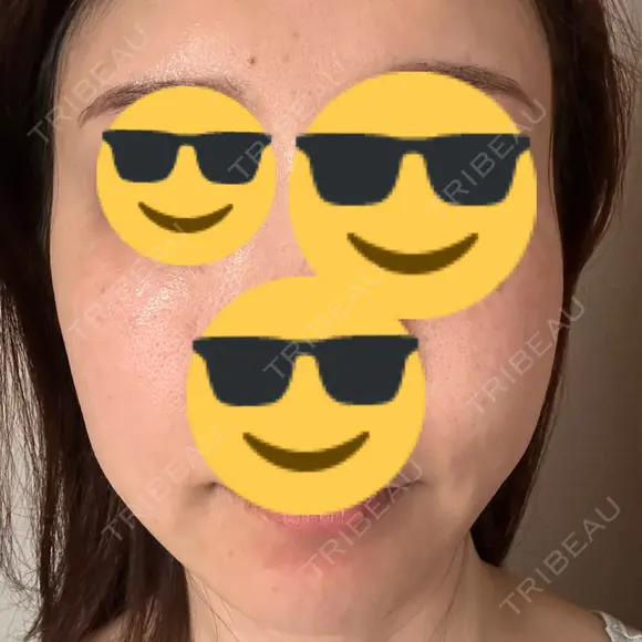 水光注射（ハリ・美肌） Chloe Cheongdam Clinic （クロエチョンダムクリニック） AFTER メイン用
