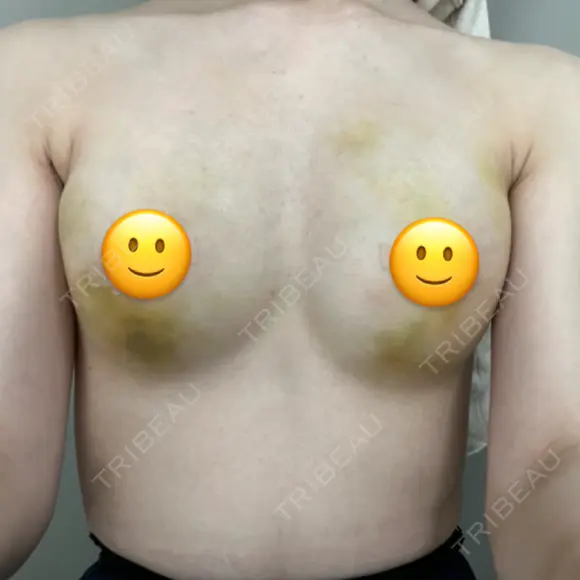 脂肪吸引（脚） / 豊胸（脂肪注入） Lipo Clinic omotesando DAY 4 メイン用