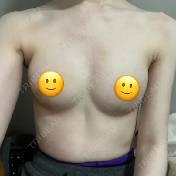 脂肪吸引（脚） / 豊胸（脂肪注入） Lipo Clinic omotesando DAY 16 メイン用