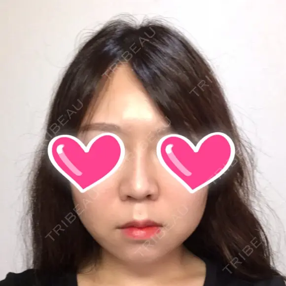 隆鼻術 / 鼻尖形成（切開） / 鼻中隔延長（切開） / 小鼻縮小（切開） ザ・プラス美容外科 AFTER メイン用