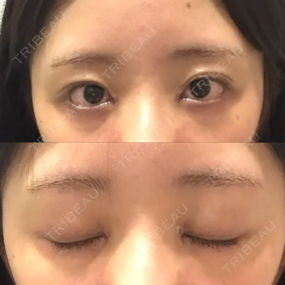 目頭切開 聖心美容クリニック 福岡院 DAY 5 メイン用