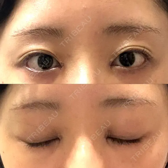 目頭切開 聖心美容クリニック 福岡院 DAY 6 メイン用