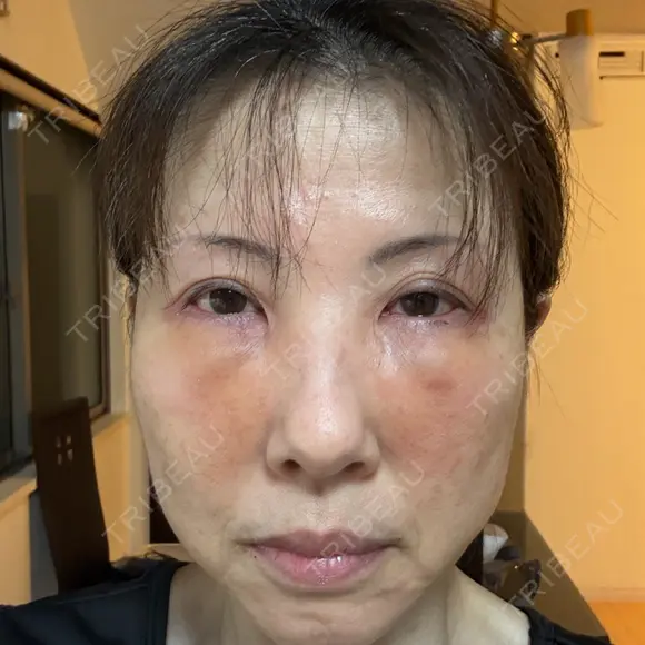 クマ治療 NARU Beauty Clinic 【ナルクリ】 DAY 2 メイン用