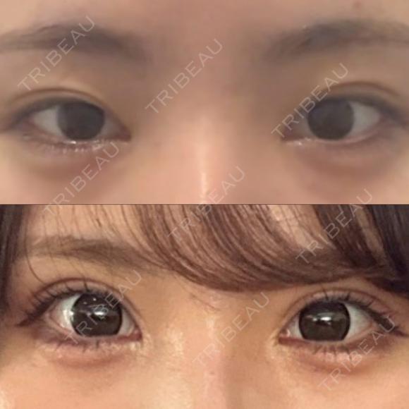目頭切開 / タレ目形成・グラマラスライン（埋没） ネビュラクリニック 東京錦糸町院 AFTER メイン用