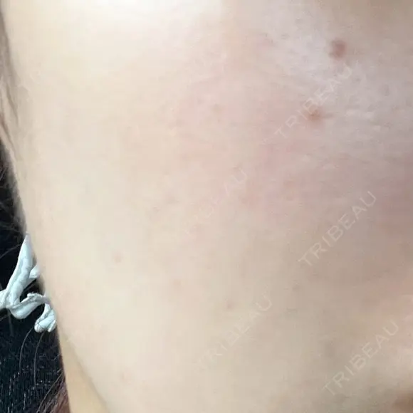 肌育注射（ジュベルックなど） / イオン導入 / 光治療（フォトフェイシャルなど） / ルメッカ Belle Via Clinic AFTER メイン用