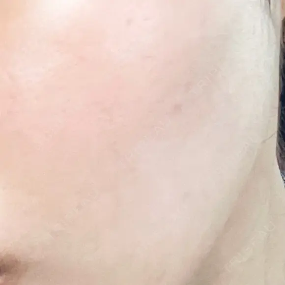 肌育注射（ジュベルックなど） / イオン導入 / 光治療（フォトフェイシャルなど） / ルメッカ Belle Via Clinic DAY 23 メイン用