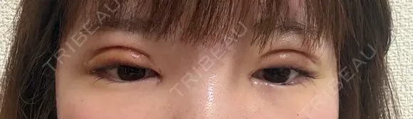 二重切開 / 目頭切開 / 眼瞼下垂（切開） / 目元修正 東京シンデレラ美容外科 新宿院 DAY 5 メイン用
