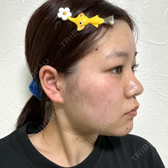 糸リフト / バッカルファット除去 / 脂肪吸引（顔） / ボトックス（口角） / ボトックス（首） アリエル美容クリニック 水戸院 DAY 37 メイン用