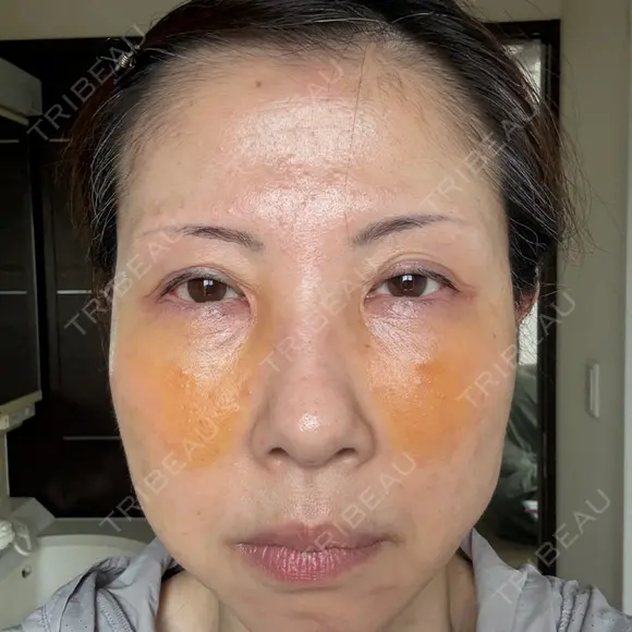 クマ治療 NARU Beauty Clinic 【ナルクリ】 DAY 4 メイン用