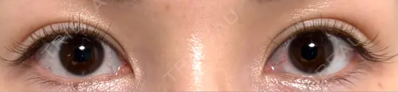二重埋没 湘南美容クリニック 千葉センシティ院 AFTER メイン用
