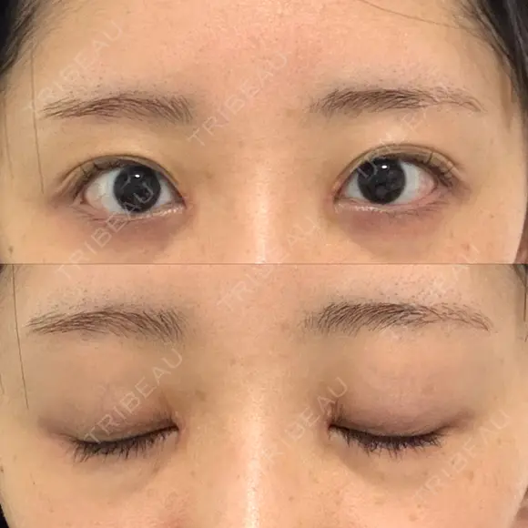 目頭切開 聖心美容クリニック 福岡院 DAY 8 メイン用