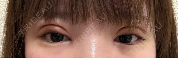二重切開 / 目頭切開 / 眼瞼下垂（切開） / 目元修正 東京シンデレラ美容外科 新宿院 DAY 6 メイン用