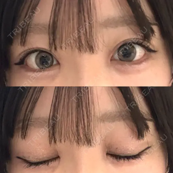 目頭切開 聖心美容クリニック 福岡院 DAY 9 メイン用