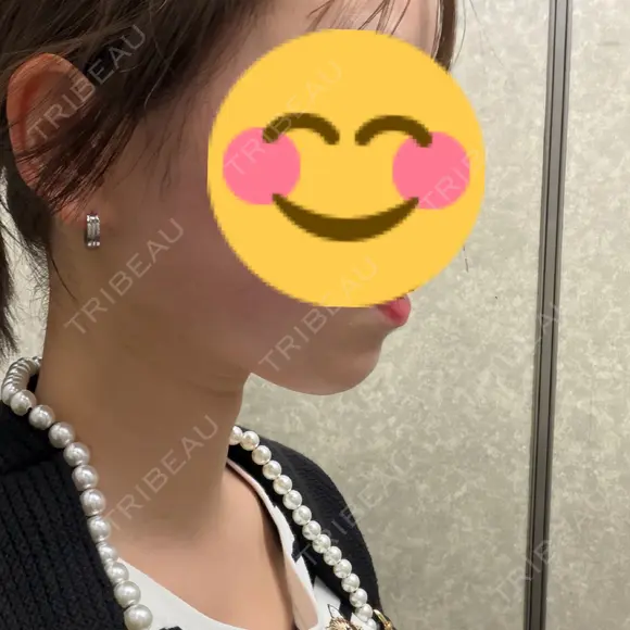 ハイフ（顔） HINATA クリニック DAY 0 メイン用