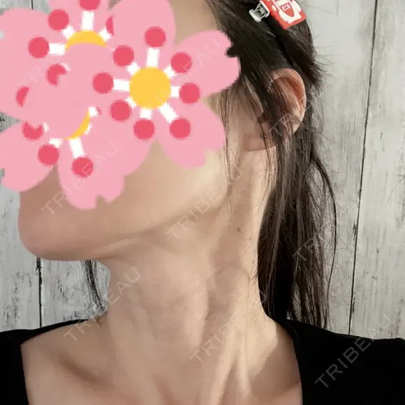 ルメッカ / インモード Moon Beauty Clinic DAY 15 メイン用