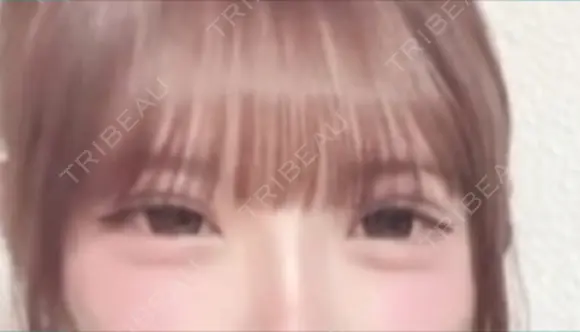 二重埋没 / 上まぶたの脂肪取り アリエル美容クリニック 郡山院 DAY 22 メイン用