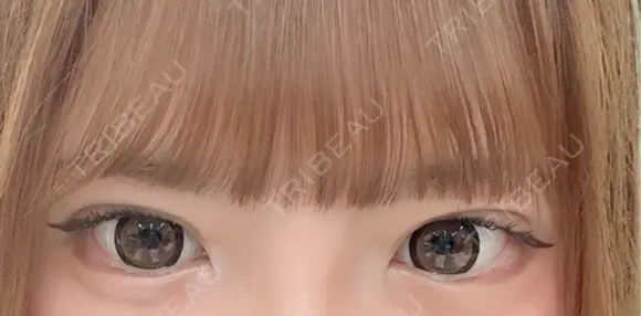 二重埋没 / 上まぶたの脂肪取り アリエル美容クリニック 郡山院 AFTER メイン用