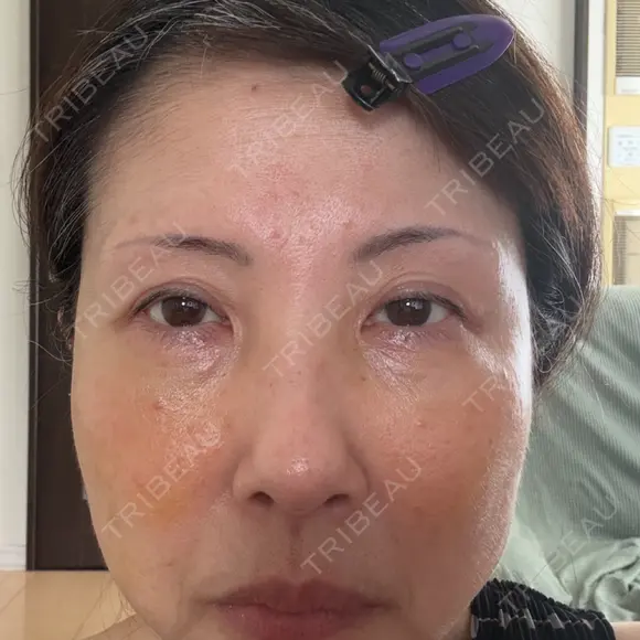 クマ治療 NARU Beauty Clinic 【ナルクリ】 DAY 7 メイン用
