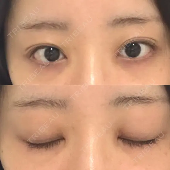 目頭切開 聖心美容クリニック 福岡院 DAY 11 メイン用