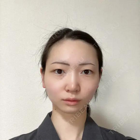 鼻尖形成（切開） / 小鼻縮小（切開） / 軟骨移植 / 鼻尖縮小 / 鼻孔縁下降 アリエル美容クリニック 郡山院 DAY 28 メイン用