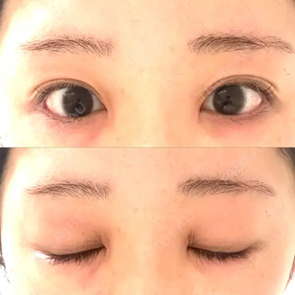 目頭切開 聖心美容クリニック 福岡院 DAY 13 メイン用