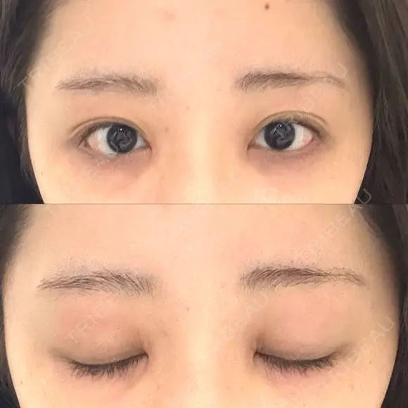 目頭切開 聖心美容クリニック 福岡院 AFTER メイン用