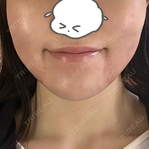 インモード PureMe Skin Clinic（ピュアミースキンクリニック麻布） AFTER メイン用