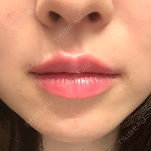 ヒアルロン酸注入（唇） PRO CLINIC プロクリニック 銀座院 AFTER メイン用