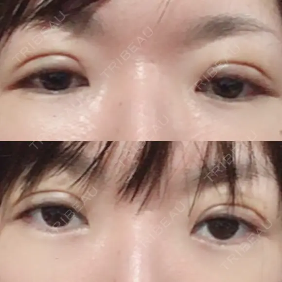 二重切開 / 上まぶたの脂肪取り 樹のひかり 形成外科・皮ふ科 DAY 6 メイン用