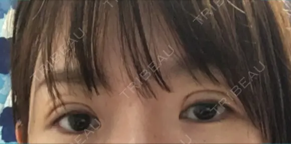 二重切開 / 上まぶたの脂肪取り 樹のひかり 形成外科・皮ふ科 DAY 8 メイン用