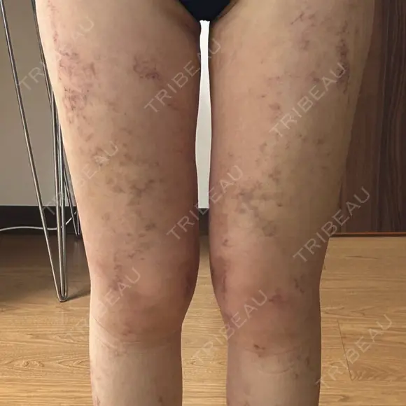 脂肪吸引（脚） Lipo Clinic omotesando DAY 18 メイン用