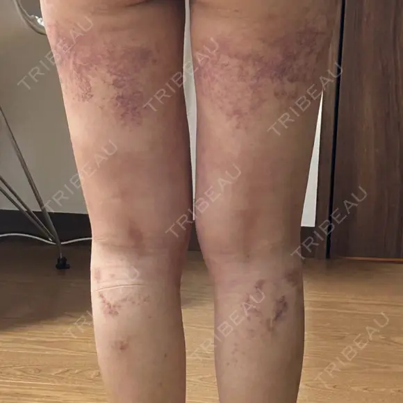 脂肪吸引（脚） Lipo Clinic omotesando DAY 18 メイン用