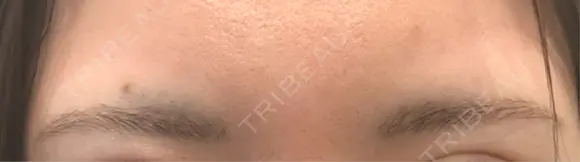 アートメイク（眉） APスキンクリニック銀座 DAY 9 メイン用