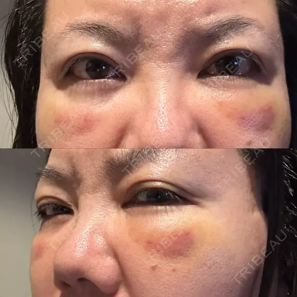 クマ治療 PRISM Beauty Clinic 町田院 DAY 7 メイン用